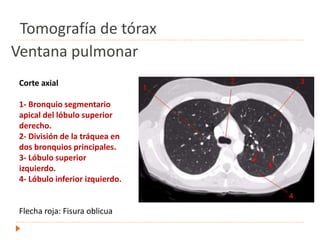 Ventana pulmonar
Corte axial
1- Bronquio segmentario
apical del lóbulo superior
derecho.
2- División de la tráquea en
dos bronquios principales.
3- Lóbulo superior
izquierdo.
4- Lóbulo inferior izquierdo.
Flecha roja: Fisura oblicua
Tomografía de tórax
 