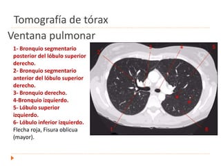 Ventana pulmonar
1- Bronquio segmentario
posterior del lóbulo superior
derecho.
2- Bronquio segmentario
anterior del lóbulo superior
derecho.
3- Bronquio derecho.
4-Bronquio izquierdo.
5- Lóbulo superior
izquierdo.
6- Lóbulo inferior izquierdo.
Flecha roja, Fisura oblicua
(mayor).
Tomografía de tórax
 
