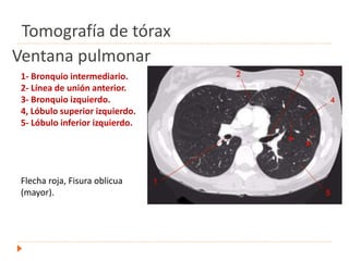 Ventana pulmonar
1- Bronquio intermediario.
2- Línea de unión anterior.
3- Bronquio izquierdo.
4, Lóbulo superior izquierdo.
5- Lóbulo inferior izquierdo.
Flecha roja, Fisura oblicua
(mayor).
Tomografía de tórax
 