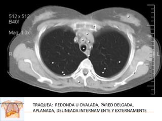 TRAQUEA: REDONDA U OVALADA, PARED DELGADA,
APLANADA, DELINEADA INTERNAMENTE Y EXTERNAMENTE
 