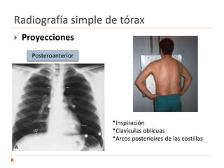 Radiografía simple de tórax
 Proyecciones
Posteroanterior
*Inspiración
*Clavículas oblicuas
*Arcos posterioires de las costillas
 