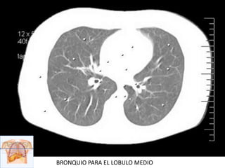 BRONQUIO PARA EL LOBULO MEDIO
 
