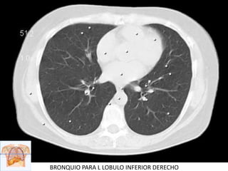 BRONQUIO PARA L LOBULO INFERIOR DERECHO
 