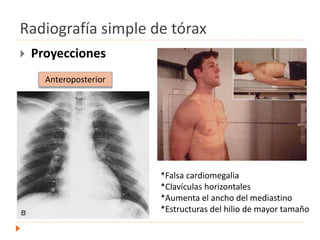 Radiografía simple de tórax
 Proyecciones
Anteroposterior
*Falsa cardiomegalia
*Clavículas horizontales
*Aumenta el ancho del mediastino
*Estructuras del hilio de mayor tamaño
 