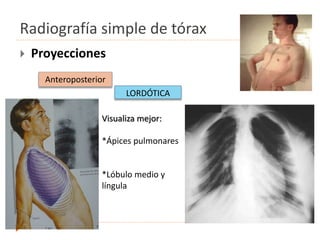 Radiografía simple de tórax
 Proyecciones
Anteroposterior
Visualiza mejor:
*Ápices pulmonares
*Lóbulo medio y
língula
LORDÓTICA
 