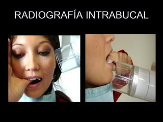 RADIOGRAFÍA INTRABUCAL 