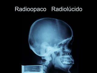 Radioopaco  Radiolúcido 