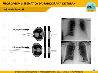2as JORNADAS GIMGAS | GRUPO DE INTERNOS DE MEDICINA GERAL E FAMILIAR DE ALMADA SEIXAL
ABORDAGEM SISTEMÁTICA DA RADIOGRAFIA DE TÓRAX
Incidência PA vs AP
10
 