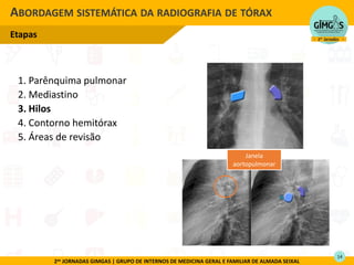 2as JORNADAS GIMGAS | GRUPO DE INTERNOS DE MEDICINA GERAL E FAMILIAR DE ALMADA SEIXAL
ABORDAGEM SISTEMÁTICA DA RADIOGRAFIA DE TÓRAX
Etapas
1. Parênquima pulmonar
2. Mediastino
3. Hilos
4. Contorno hemitórax
5. Áreas de revisão
Janela
aortopulmonar
14
 