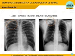 2as JORNADAS GIMGAS | GRUPO DE INTERNOS DE MEDICINA GERAL E FAMILIAR DE ALMADA SEIXAL
• Ápex – acima das clavículas; pneumotórax, neoplasias
ABORDAGEM SISTEMÁTICA DA RADIOGRAFIA DE TÓRAX
Áreas de revisão

18
 