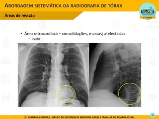 2as JORNADAS GIMGAS | GRUPO DE INTERNOS DE MEDICINA GERAL E FAMILIAR DE ALMADA SEIXAL
• Área retrocardíaca – consolidações, massas; atelectasias
• Perfil
ABORDAGEM SISTEMÁTICA DA RADIOGRAFIA DE TÓRAX
Áreas de revisão

20
 