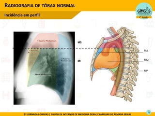 2as JORNADAS GIMGAS | GRUPO DE INTERNOS DE MEDICINA GERAL E FAMILIAR DE ALMADA SEIXAL
RADIOGRAFIA DE TÓRAX NORMAL
Incidência em perfil
21
MA
MM
MP
MS
MI
 