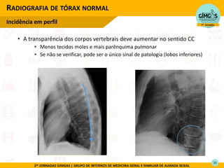 2as JORNADAS GIMGAS | GRUPO DE INTERNOS DE MEDICINA GERAL E FAMILIAR DE ALMADA SEIXAL
RADIOGRAFIA DE TÓRAX NORMAL
Incidência em perfil
23
• A transparência dos corpos vertebrais deve aumentar no sentido CC
• Menos tecidos moles e mais parênquima pulmonar
• Se não se verificar, pode ser o único sinal de patologia (lobos inferiores)
 