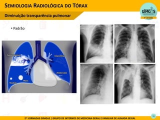 2as JORNADAS GIMGAS | GRUPO DE INTERNOS DE MEDICINA GERAL E FAMILIAR DE ALMADA SEIXAL
SEMIOLOGIA RADIOLÓGICA DO TÓRAX
Diminuição transparência pulmonar
31
• Padrão
 