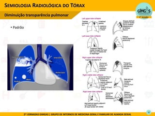 2as JORNADAS GIMGAS | GRUPO DE INTERNOS DE MEDICINA GERAL E FAMILIAR DE ALMADA SEIXAL
SEMIOLOGIA RADIOLÓGICA DO TÓRAX
Diminuição transparência pulmonar
32
• Padrão
 