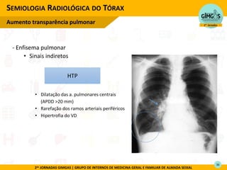 2as JORNADAS GIMGAS | GRUPO DE INTERNOS DE MEDICINA GERAL E FAMILIAR DE ALMADA SEIXAL
- Enfisema pulmonar
• Sinais indiretos
• Dilatação das a. pulmonares centrais
(APDD >20 mm)
• Rarefação dos ramos arteriais periféricos
• Hipertrofia do VD
SEMIOLOGIA RADIOLÓGICA DO TÓRAX
Aumento transparência pulmonar
HTP
36
 