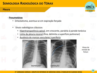 2as JORNADAS GIMGAS | GRUPO DE INTERNOS DE MEDICINA GERAL E FAMILIAR DE ALMADA SEIXAL
- Pneumotórax
• Ortostatismo, acentua-se em expiração forçada
• Sinais radiológicos clássicos
• Hipertransparência apical, em crescente, paralela à parede torácica
• Linha da pleura visceral (fina, delimita a superfície pulmonar)
• Ausência de marcas vasculares à periferia
SEMIOLOGIA RADIOLÓGICA DO TÓRAX
Pleura
INSPIRAÇÃO EXPIRAÇÃO
Áreas de
revisão de
Felson
40
 