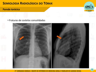 2as JORNADAS GIMGAS | GRUPO DE INTERNOS DE MEDICINA GERAL E FAMILIAR DE ALMADA SEIXAL
• Fraturas de costelas consolidadas
SEMIOLOGIA RADIOLÓGICA DO TÓRAX
Parede torácica
42
 