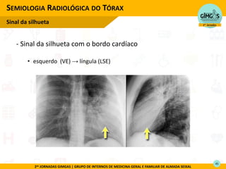 2as JORNADAS GIMGAS | GRUPO DE INTERNOS DE MEDICINA GERAL E FAMILIAR DE ALMADA SEIXAL
SEMIOLOGIA RADIOLÓGICA DO TÓRAX
Sinal da silhueta
- Sinal da silhueta com o bordo cardíaco
• esquerdo (VE) → língula (LSE)
45
 