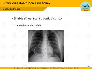 2as JORNADAS GIMGAS | GRUPO DE INTERNOS DE MEDICINA GERAL E FAMILIAR DE ALMADA SEIXAL
SEMIOLOGIA RADIOLÓGICA DO TÓRAX
Sinal da silhueta
- Sinal da silhueta com o bordo cardíaco
• direito → lobo médio
46
 