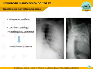 2as JORNADAS GIMGAS | GRUPO DE INTERNOS DE MEDICINA GERAL E FAMILIAR DE ALMADA SEIXAL
• Achados específicos
• Localizam patologia
ao parênquima pulmonar
SEMIOLOGIA RADIOLÓGICA DO TÓRAX
Broncograma e alveolograma aéreo
Preenchimento alveolar
47
 