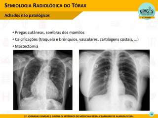 2as JORNADAS GIMGAS | GRUPO DE INTERNOS DE MEDICINA GERAL E FAMILIAR DE ALMADA SEIXAL
• Pregas cutâneas, sombras dos mamilos
• Cal ifi aç es t a ueia e uios, vas ula es, a tilage s ostais, …
• Mastectomia
SEMIOLOGIA RADIOLÓGICA DO TÓRAX
Achados não patológicos
48
 