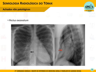 2as JORNADAS GIMGAS | GRUPO DE INTERNOS DE MEDICINA GERAL E FAMILIAR DE ALMADA SEIXAL
• Pectus excavatum
SEMIOLOGIA RADIOLÓGICA DO TÓRAX
Achados não patológicos
49
 