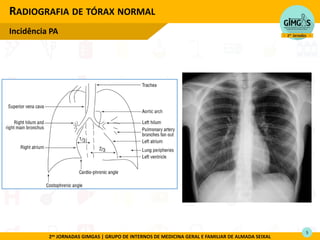 2as JORNADAS GIMGAS | GRUPO DE INTERNOS DE MEDICINA GERAL E FAMILIAR DE ALMADA SEIXAL
RADIOGRAFIA DE TÓRAX NORMAL
Incidência PA
5
 