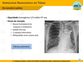 2as JORNADAS GIMGAS | GRUPO DE INTERNOS DE MEDICINA GERAL E FAMILIAR DE ALMADA SEIXAL
• Opacidade homogénea 1/3 médio HT esq
• Sinais de retração
• Desvio homolateral da
traqueia e mediastino
• Subida hilo esq
•  espaços intercostais
• Obliquidade arcos costais post
SEMIOLOGIA RADIOLÓGICA DO TÓRAX
Do conceito à prática
Fibrose pulmonar
51
 