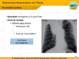 2as JORNADAS GIMGAS | GRUPO DE INTERNOS DE MEDICINA GERAL E FAMILIAR DE ALMADA SEIXAL
• Opacidade homogénea 1/3 sup HT dto
• Sinais de retração
• Desvio peq cisura
• Atelectasia LSD
• Sinal do “ de Golde
SEMIOLOGIA RADIOLÓGICA DO TÓRAX
Do conceito à prática
Carcinoma
broncogénico
52
 