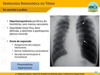 2as JORNADAS GIMGAS | GRUPO DE INTERNOS DE MEDICINA GERAL E FAMILIAR DE ALMADA SEIXAL
• Hipertransparência periférica do
hemitórax, sem marcas vasculares
• Opacidade linear fina, bem
definida, a delimitar o parênquima
(pleura visceral)
• Sinais de expansão
• Alargamento dos espaços
intercostais
• Desvio mediastínico contralateral
• Descida da hemicúpula d.
homolateral
• Descida do diafragma
SEMIOLOGIA RADIOLÓGICA DO TÓRAX
Do conceito à prática
Pneumotórax
hipertensivo
53
 