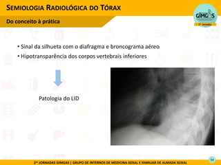 2as JORNADAS GIMGAS | GRUPO DE INTERNOS DE MEDICINA GERAL E FAMILIAR DE ALMADA SEIXAL
• Sinal da silhueta com o diafragma e broncograma aéreo
• Hipotransparência dos corpos vertebrais inferiores
SEMIOLOGIA RADIOLÓGICA DO TÓRAX
Do conceito à prática
Patologia do LID
54
 