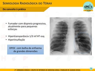 2as JORNADAS GIMGAS | GRUPO DE INTERNOS DE MEDICINA GERAL E FAMILIAR DE ALMADA SEIXAL
• Fumador com dispneia progressiva,
atualmente para pequenos
esforços
• Hipertransparência 1/3 inf HT esq
• Hiperinsuflação
SEMIOLOGIA RADIOLÓGICA DO TÓRAX
Do conceito à prática
DPOC com bolha de enfisema
de grandes dimensões
55
 