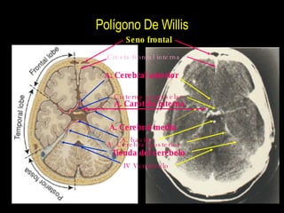 Polígono De Willis Seno frontal Cresta frontal interna A. Cerebral anterior Cisterna supraselar A. Carótida interna A. bas...