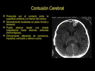 Contusión Cerebral <ul><li>Producida por el contacto entre la superficie cerebral y el interior del cráneo. </li></ul><ul>...