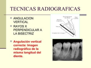 TECNICAS RADIOGRAFICAS
 ANGULACION
VERTICAL
 RAYOS X
PERPENDICULAR A
LA BISECTRIZ
 Angulación vertical
correcta: Imagen
radiográfica de la
misma longitud del
diente.
 