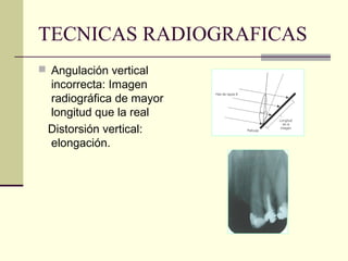 TECNICAS RADIOGRAFICAS
 Angulación vertical
incorrecta: Imagen
radiográfica de mayor
longitud que la real
Distorsión vertical:
elongación.
 