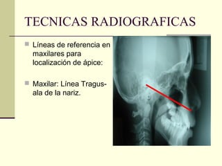 TECNICAS RADIOGRAFICAS
 Líneas de referencia en
maxilares para
localización de ápice:
 Maxilar: Línea Tragus-
ala de la nariz.
 