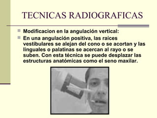 TECNICAS RADIOGRAFICAS
 Modificacion en la angulación vertical:
 En una angulación positiva, las raíces
vestibulares se alejan del cono o se acortan y las
linguales o palatinas se acercan al rayo o se
suben. Con esta técnica se puede desplazar las
estructuras anatómicas como el seno maxilar.
 