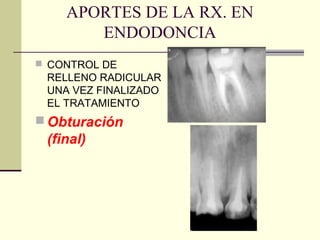 APORTES DE LA RX. EN
ENDODONCIA
 CONTROL DE
RELLENO RADICULAR
UNA VEZ FINALIZADO
EL TRATAMIENTO
 Obturación
(final)
 
