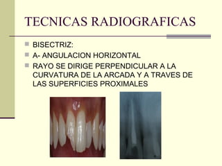 TECNICAS RADIOGRAFICAS
 BISECTRIZ:
 A- ANGULACION HORIZONTAL
 RAYO SE DIRIGE PERPENDICULAR A LA
CURVATURA DE LA ARCADA Y A TRAVES DE
LAS SUPERFICIES PROXIMALES
 