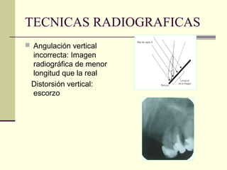 TECNICAS RADIOGRAFICAS
 Angulación vertical
incorrecta: Imagen
radiográfica de menor
longitud que la real
Distorsión vertical:
escorzo
 