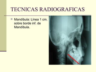 TECNICAS RADIOGRAFICAS
 Mandíbula: Línea 1 cm.
sobre borde inf. de
Mandíbula.
 