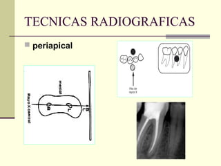TECNICAS RADIOGRAFICAS
 periapical
 