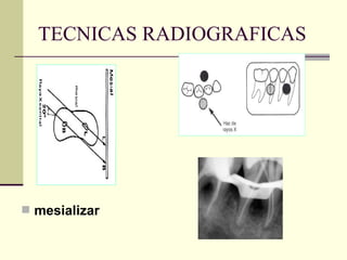 TECNICAS RADIOGRAFICAS
 mesializar
 