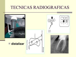 TECNICAS RADIOGRAFICAS
 distalizar
 