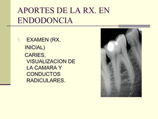 APORTES DE LA RX. EN
ENDODONCIA
1. EXAMEN (RX.
INICIAL)
CARIES,
VISUALIZACION DE
LA CAMARA Y
CONDUCTOS
RADICULARES.
 
