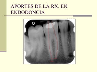 APORTES DE LA RX. EN
ENDODONCIA
 