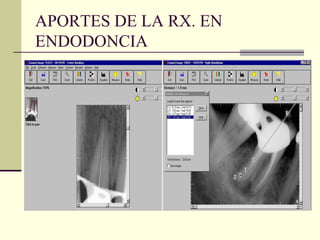 APORTES DE LA RX. EN
ENDODONCIA
 