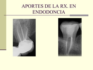 APORTES DE LA RX. EN
ENDODONCIA
 